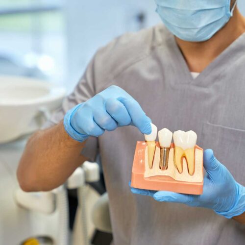 Implant Dental Treatment