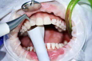 TOOTH STONE CLEANING