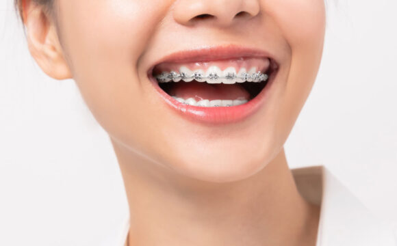 Orthodontic Dental Treatment