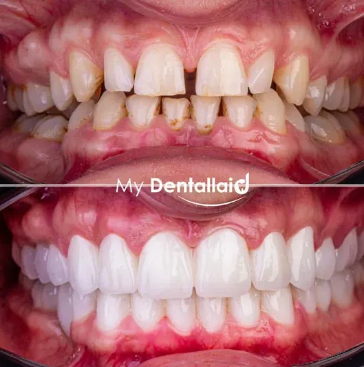 Shaved Teeth for Veneers