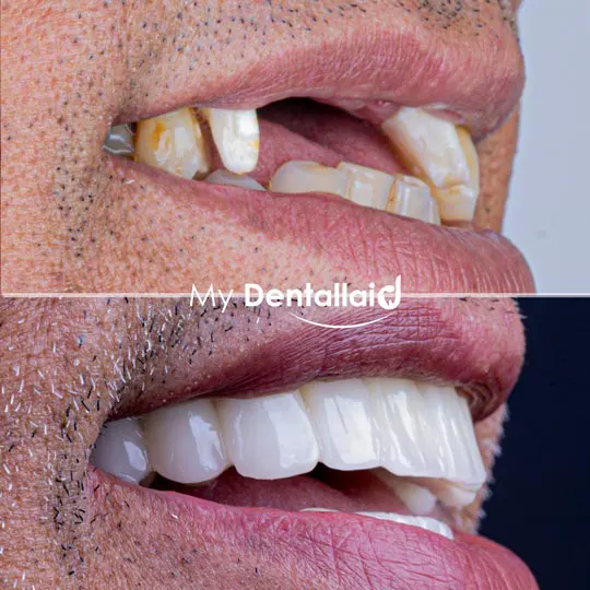 Dental-Treatment-in-Turkey-Affordable-High-Quality-Care-for-International-Patients