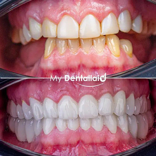 Zirconium–Porcelain-Before-After-Veneer-Comments-istanbul