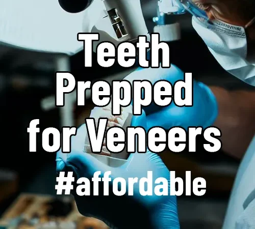 Teeth Prepped for Veneers