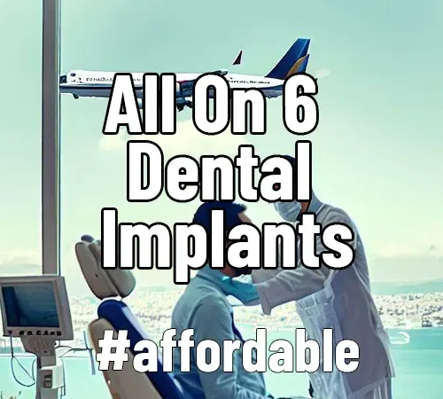 All on 6 Dental Implants All You Need To Know About