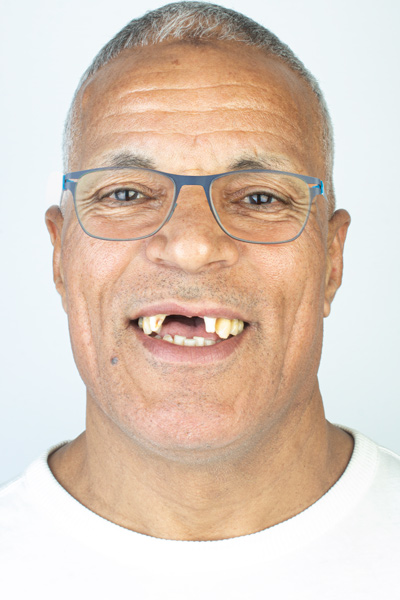 Implant Et Couronnes Dentaires Avant Après