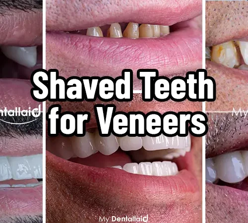 Shaved-Teeth-for-Veneers