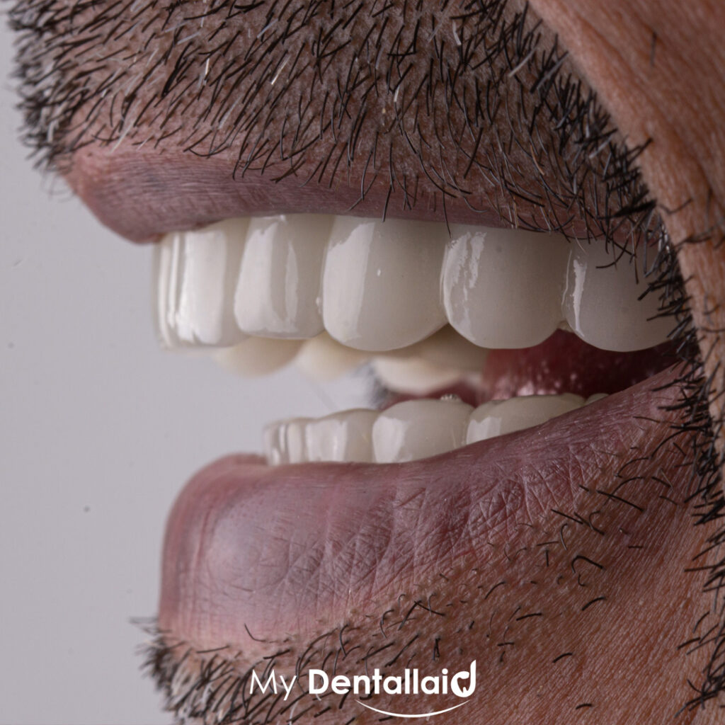 zirconia dental veneers