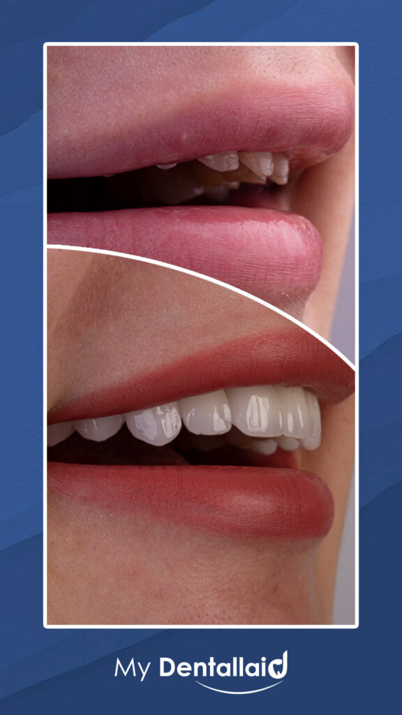 prep teeth for veneers