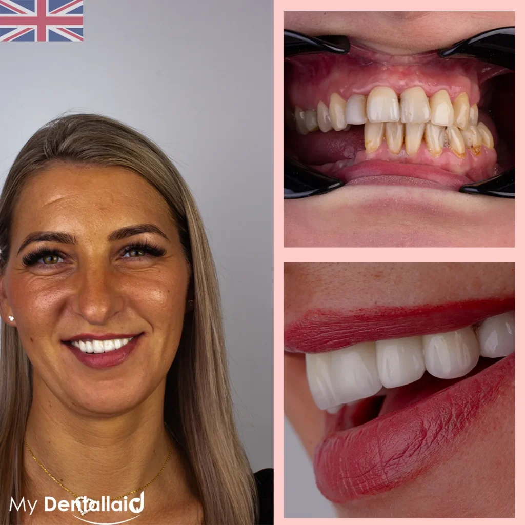 free dental implants for low income uk