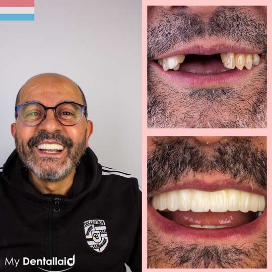How much do dental implants cost