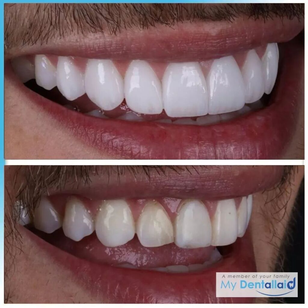 teeth prepped for veneers