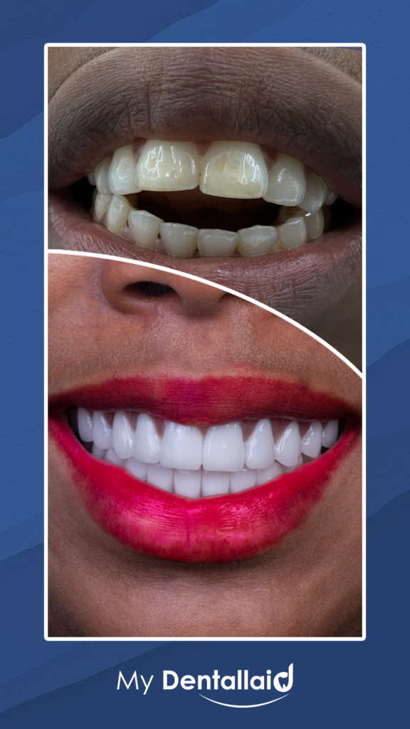 zirconium-dental-veneers