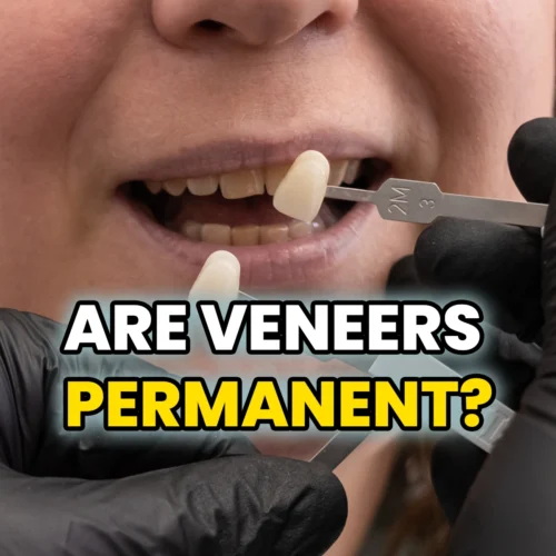 are-veneers-permanent