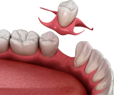 single tooth partial denture