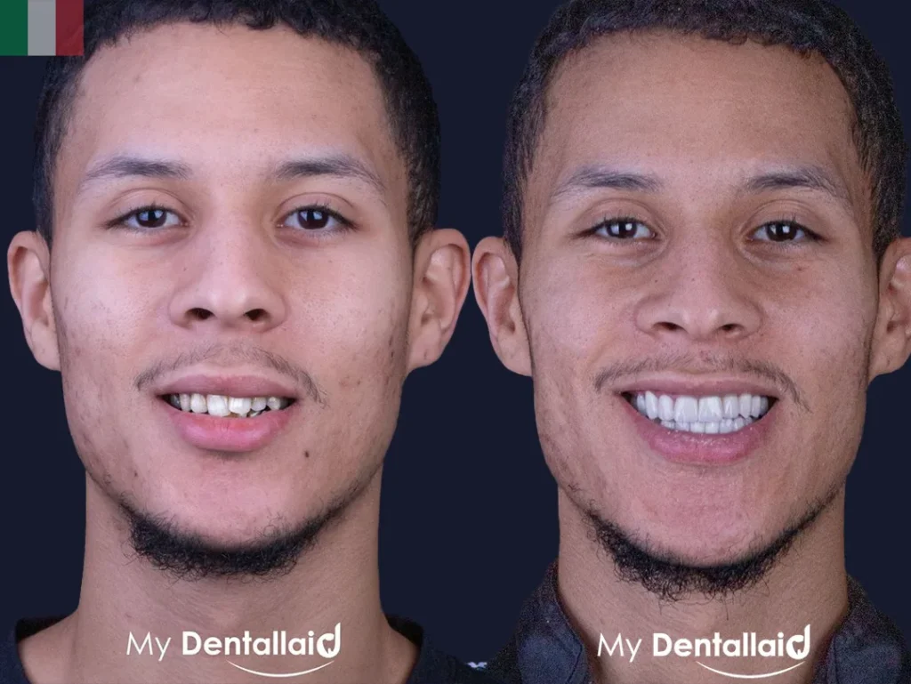 I Can't Afford a Crown on My Root Canal