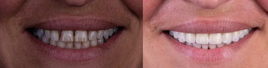 dentures-before-after